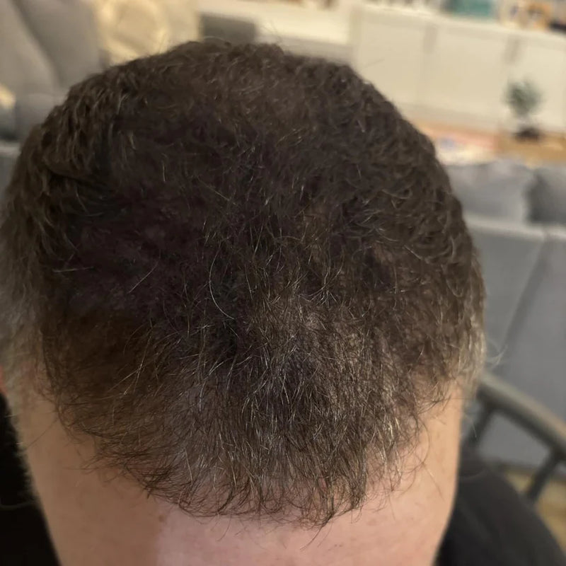 After — Línea frontal
