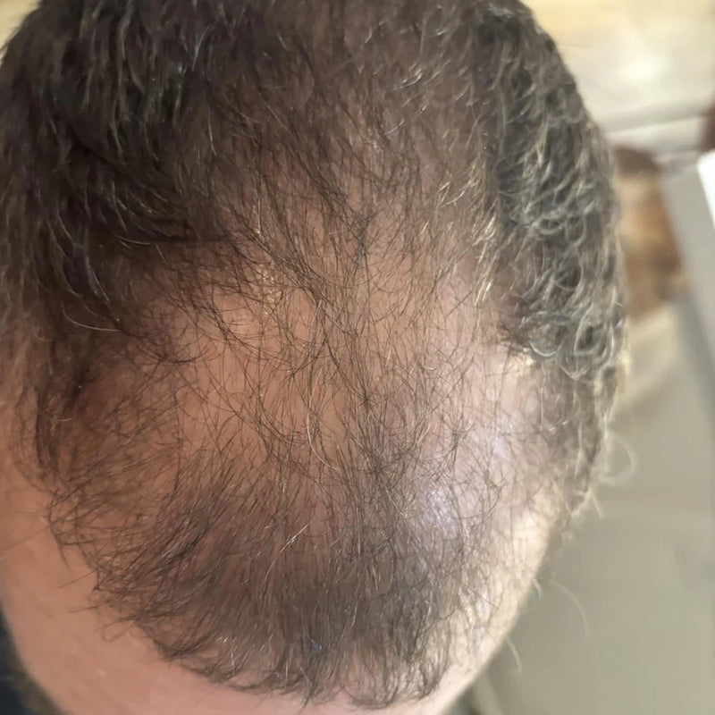 Before — Línea frontal